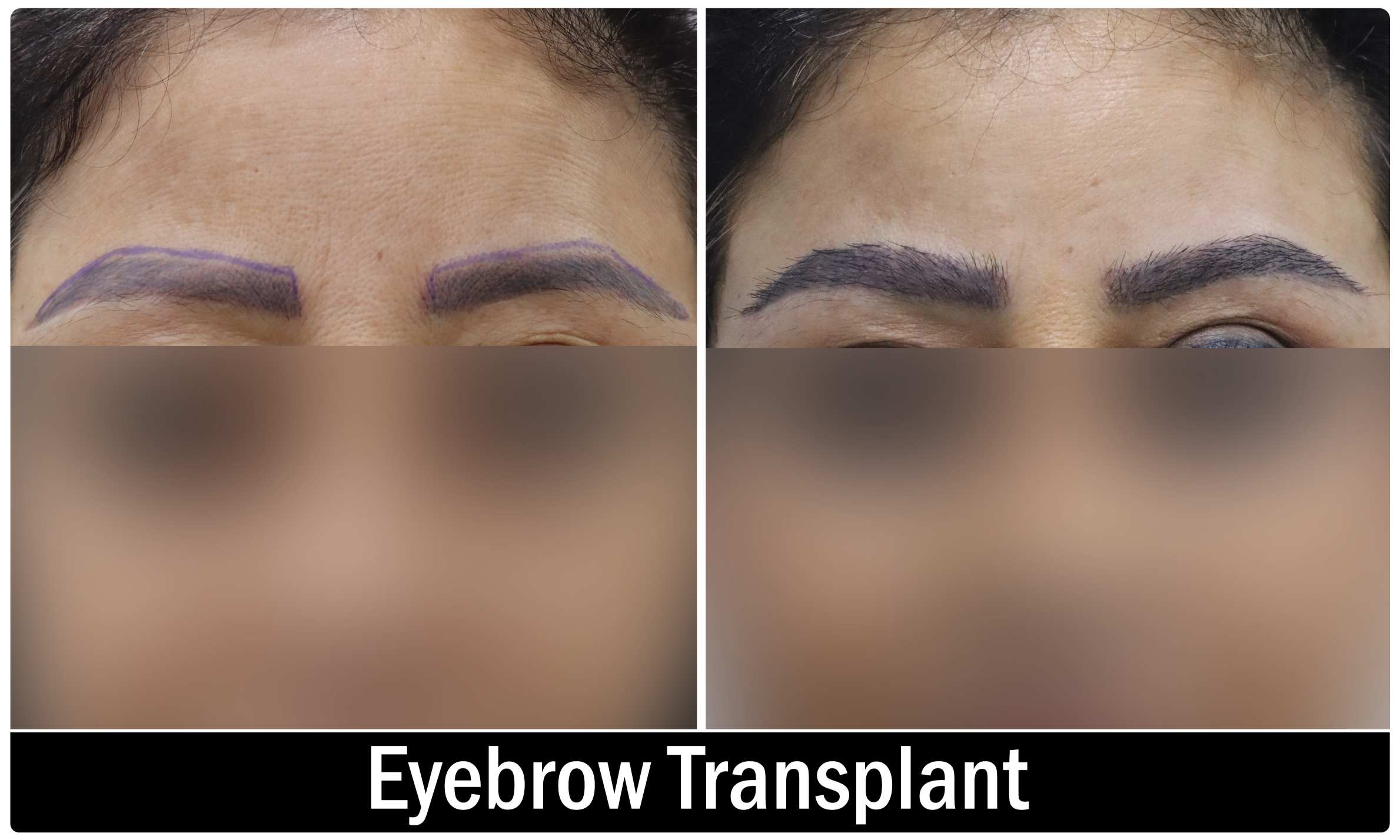 Eye brow transplant KOQ10